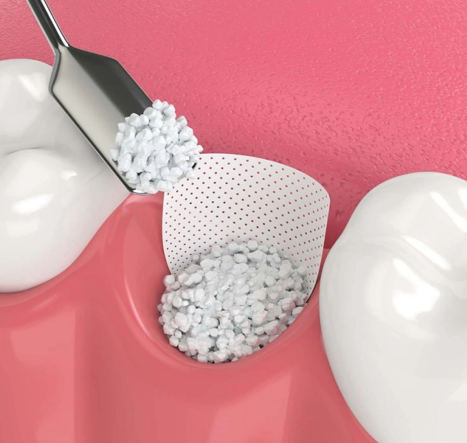 Dental filling procedure showing white composite material being applied to tooth model with instrument.