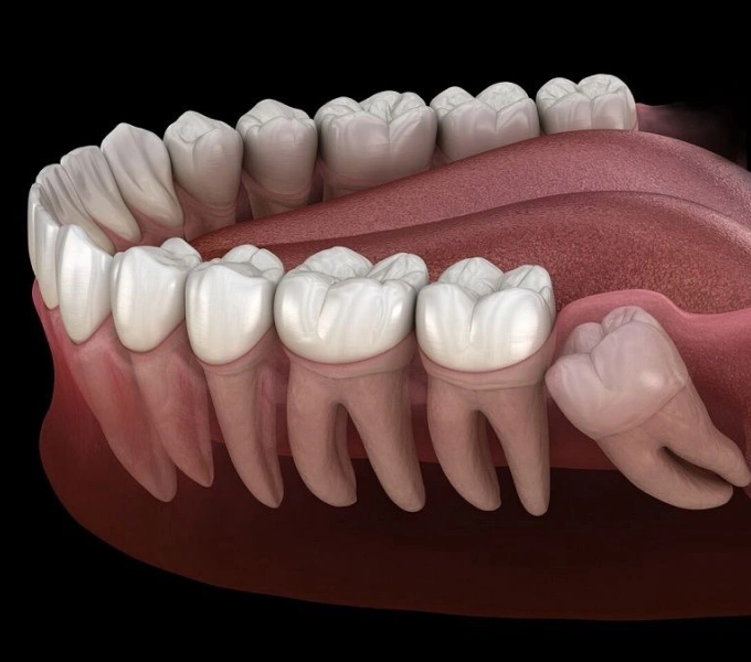 3D dental illustration showing wisdom tooth extraction anatomy and tooth positioning in jaw.