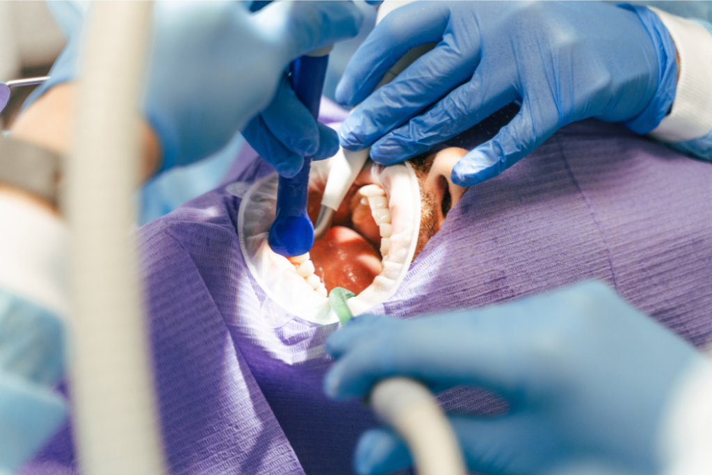 tooth extraction in Boca Raton