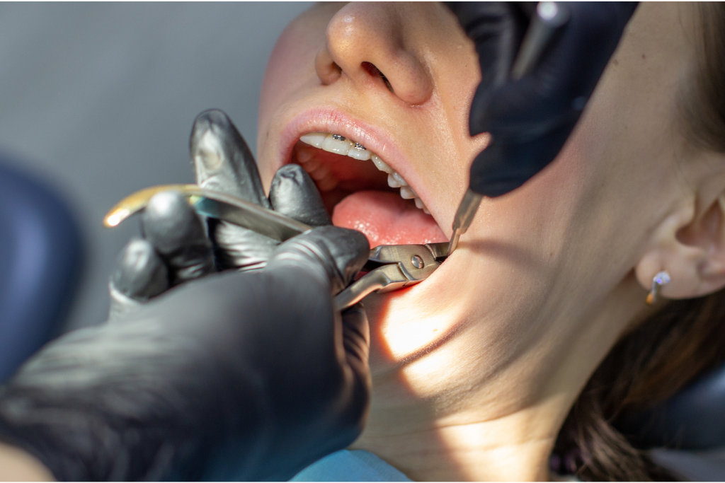 wisdom teeth removal near me in Boca Raton