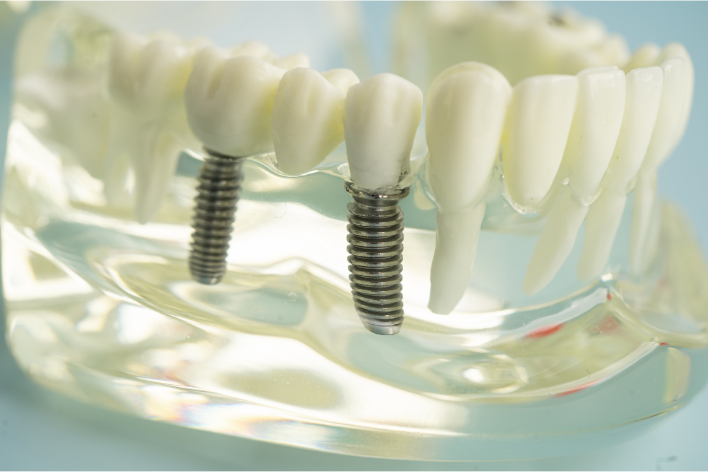 dental implants in Boca Raton
