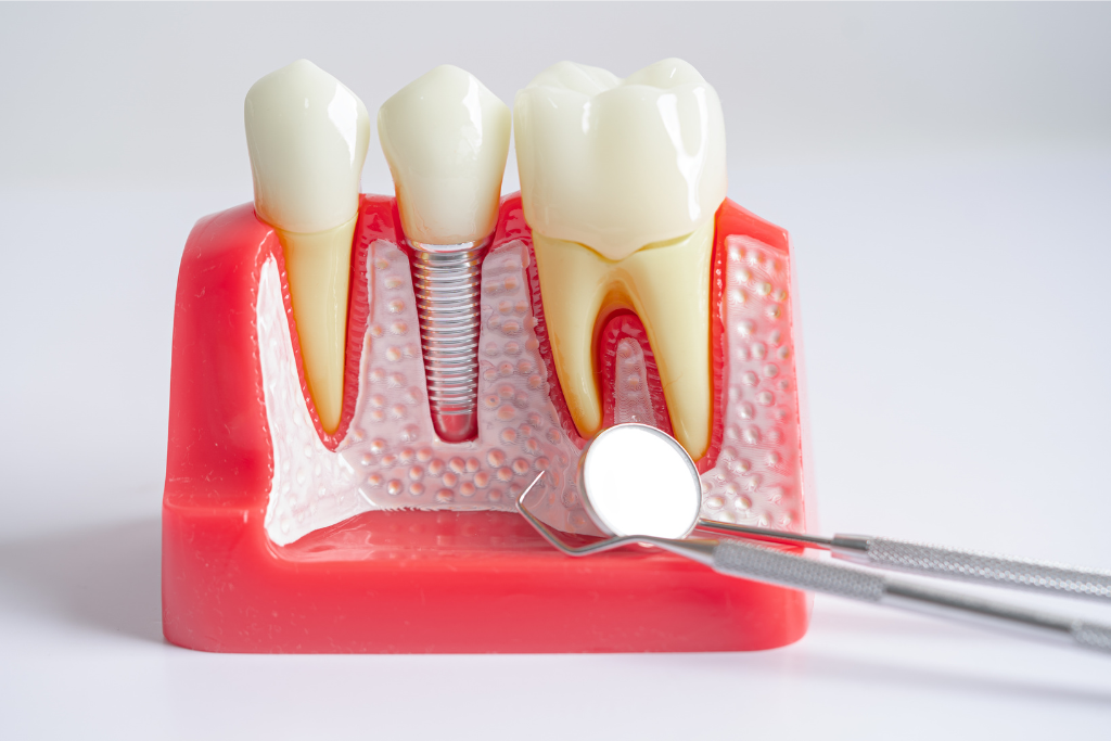 dental implants in Boca Raton