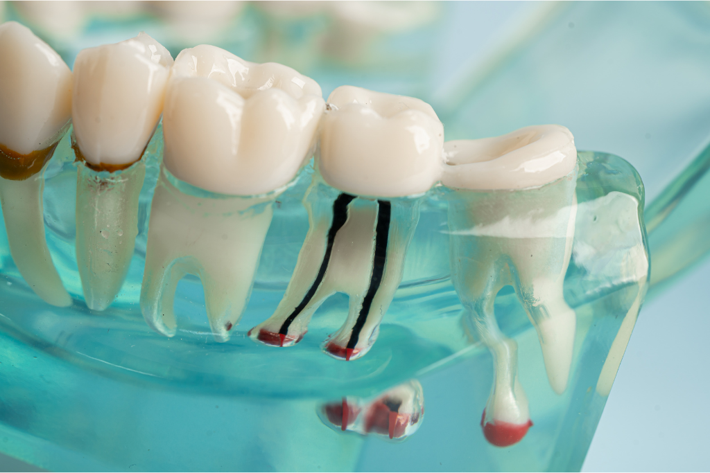 dental implants in Boca Raton