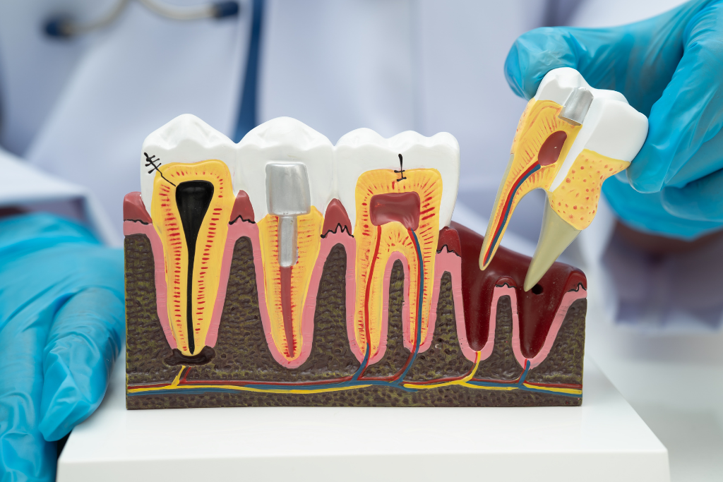 Dental implant cross-section model showing tooth anatomy, nerve pathways, and implant placement for patient education.