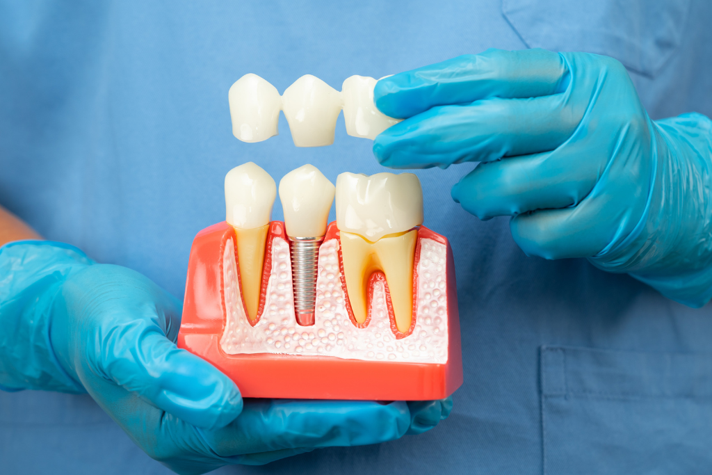 Dental implant model showing crown placement over titanium post in jawbone at Boca Raton practice.
